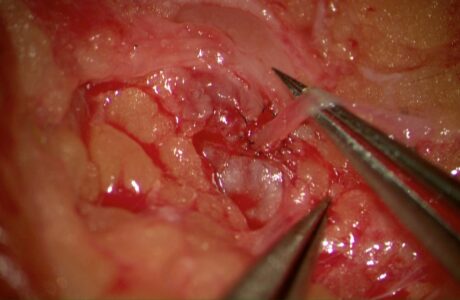 NZ’s first LNVA (Lymph Node Venous Anastamosis)