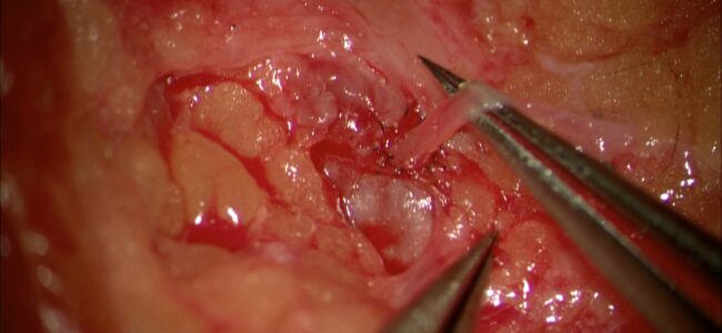 NZ’s first LNVA (Lymph Node Venous Anastamosis)